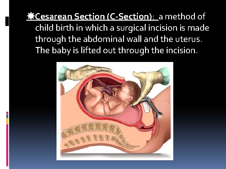 Cesarean Section (C-Section): a method of child birth in which a surgical incision Cesarean Section (C-Section): a method of child birth in which a surgical incision