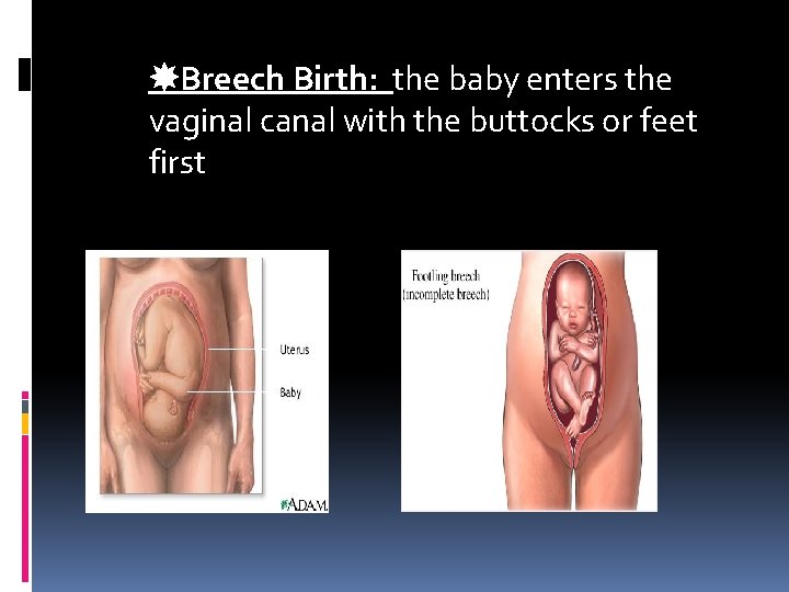 Breech Birth: the baby enters the vaginal canal with the buttocks or feet Breech Birth: the baby enters the vaginal canal with the buttocks or feet