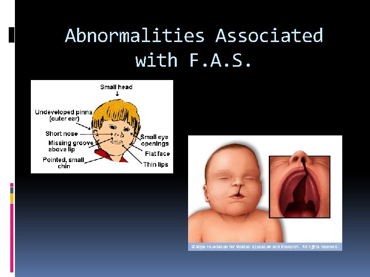 Abnormalities Associated with F. A. S. Abnormalities Associated with F. A. S.