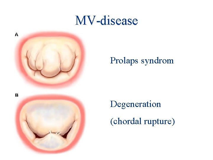 MV-disease Prolaps syndrom Degeneration (chordal rupture) 