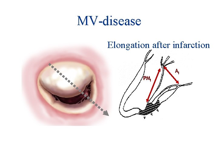 MV-disease Elongation after infarction PMI AI 