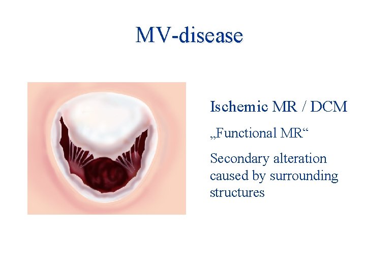 MV-disease Ischemic MR / DCM „Functional MR“ Secondary alteration caused by surrounding structures 