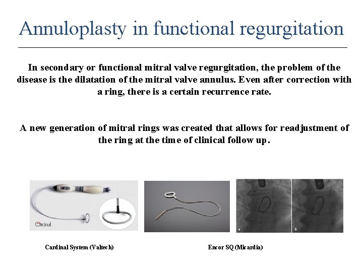 Annuloplasty in functional regurgitation In secondary or functional mitral valve regurgitation, the problem of