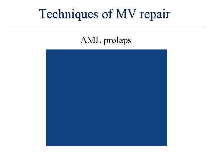 Techniques of MV repair AML prolaps 