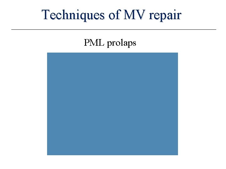 Techniques of MV repair PML prolaps 