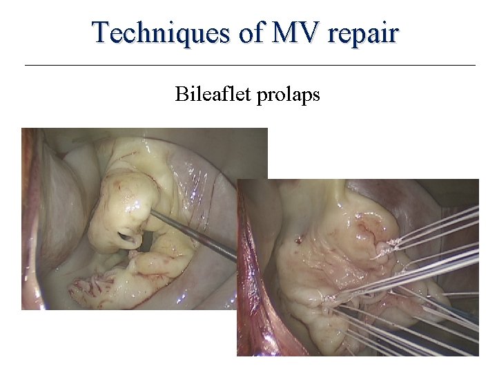 Techniques of MV repair Bileaflet prolaps 