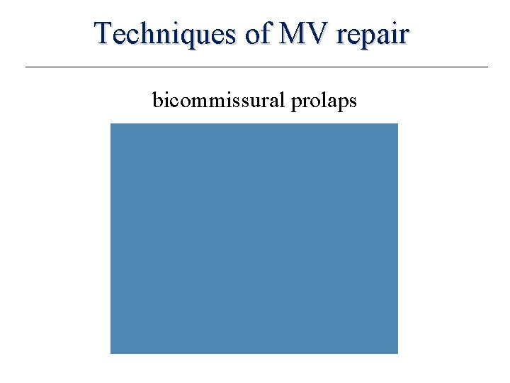 Techniques of MV repair bicommissural prolaps 