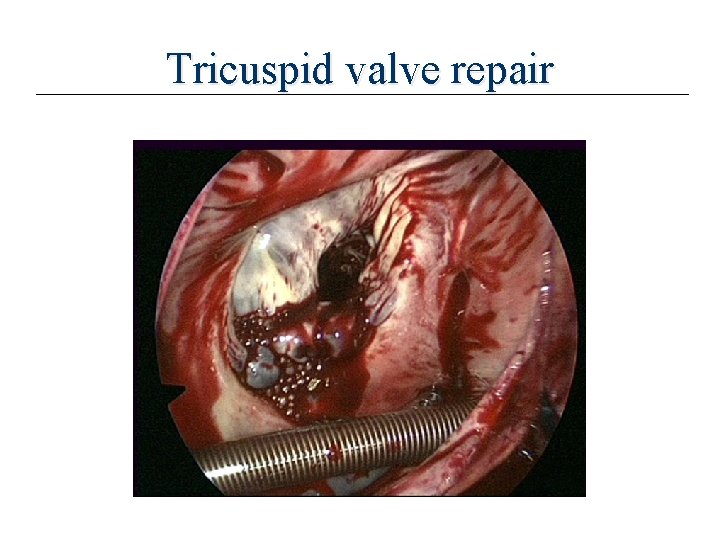 Tricuspid valve repair 