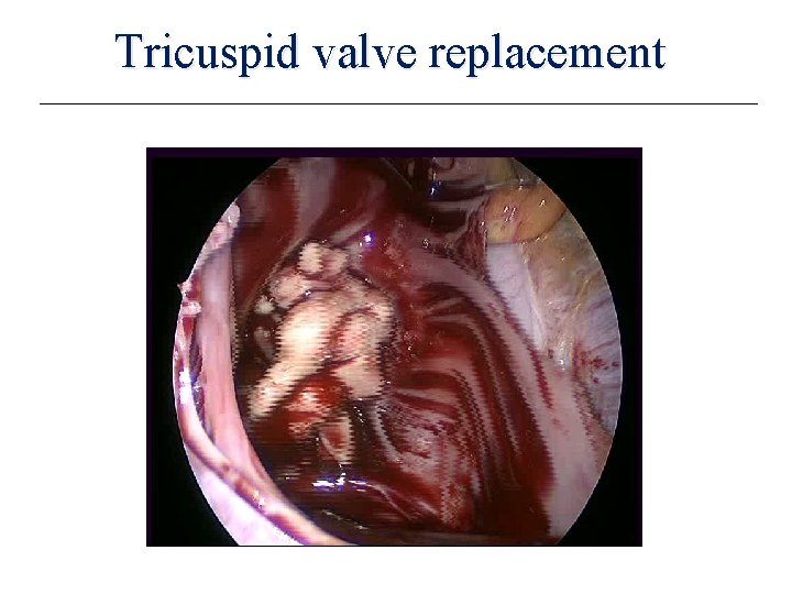 Tricuspid valve replacement 