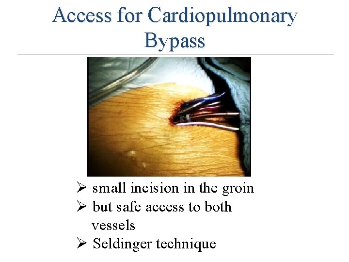 Access for Cardiopulmonary Bypass Ø small incision in the groin Ø but safe access