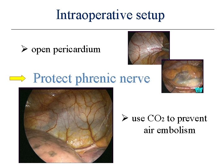 Intraoperative setup Ø open pericardium Protect phrenic nerve Ø use CO 2 to prevent