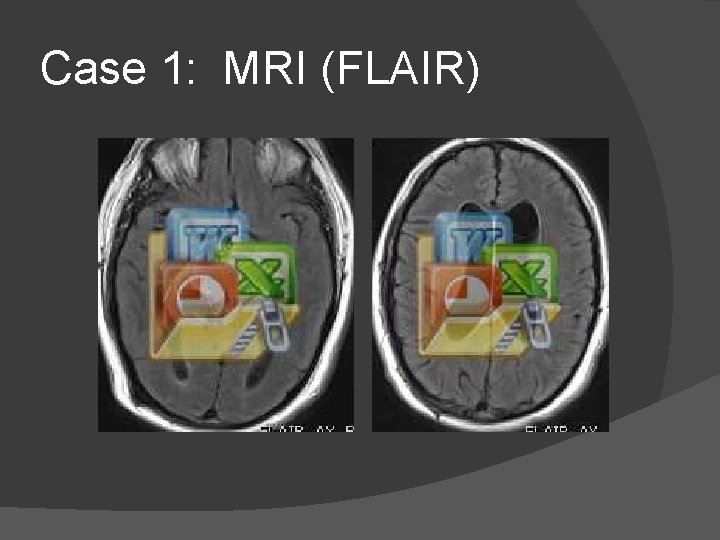 Case 1: MRI (FLAIR) 