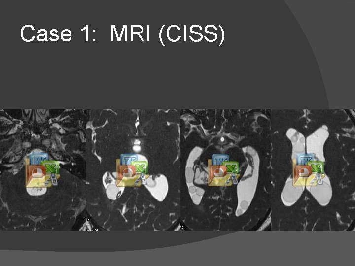 Case 1: MRI (CISS) 