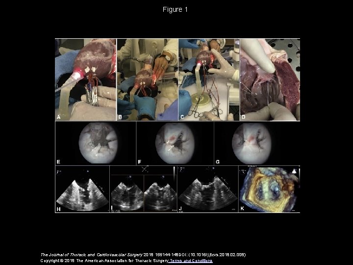 Figure 1 The Journal of Thoracic and Cardiovascular Surgery 2018 156144 -148 DOI: (10.
