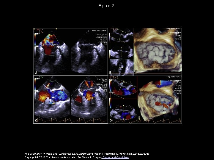 Figure 2 The Journal of Thoracic and Cardiovascular Surgery 2018 156144 -148 DOI: (10.