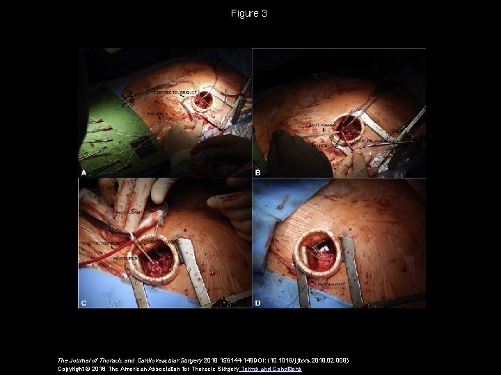 Figure 3 The Journal of Thoracic and Cardiovascular Surgery 2018 156144 -148 DOI: (10.