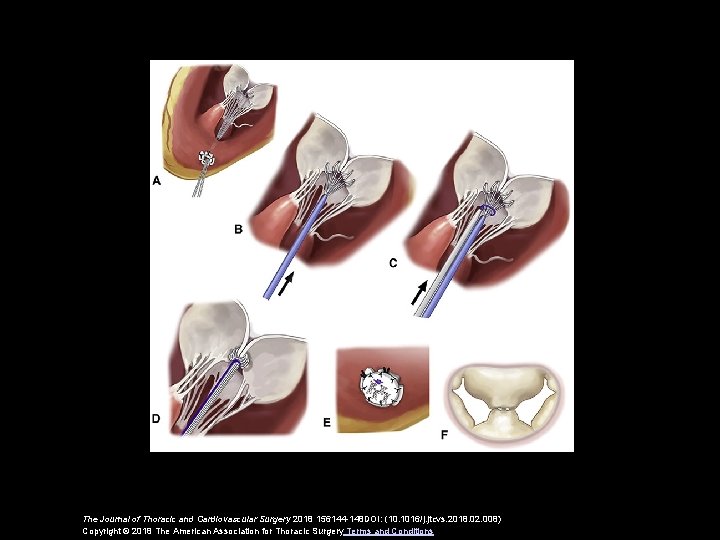 The Journal of Thoracic and Cardiovascular Surgery 2018 156144 -148 DOI: (10. 1016/j. jtcvs.