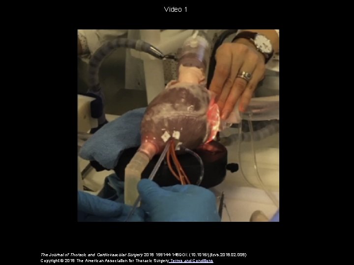 Video 1 The Journal of Thoracic and Cardiovascular Surgery 2018 156144 -148 DOI: (10.