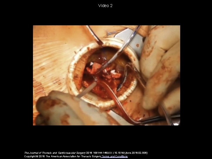 Video 2 The Journal of Thoracic and Cardiovascular Surgery 2018 156144 -148 DOI: (10.