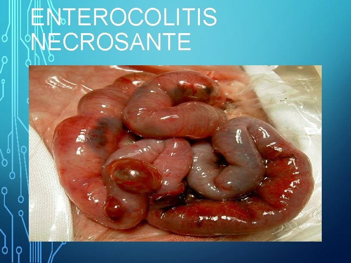 ENTEROCOLITIS NECROSANTE 