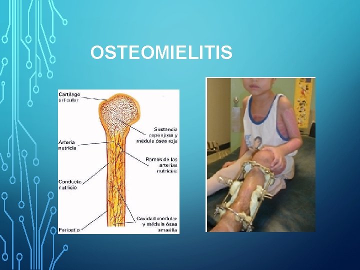 OSTEOMIELITIS 