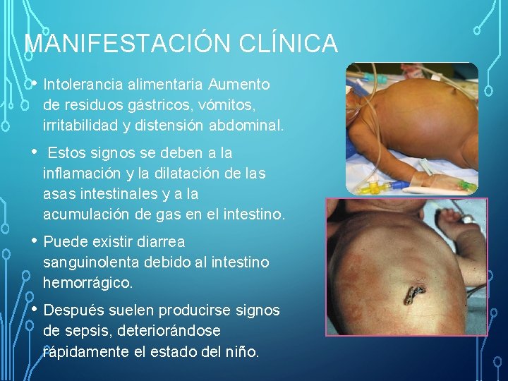 MANIFESTACIÓN CLÍNICA • Intolerancia alimentaria Aumento de residuos gástricos, vómitos, irritabilidad y distensión abdominal.
