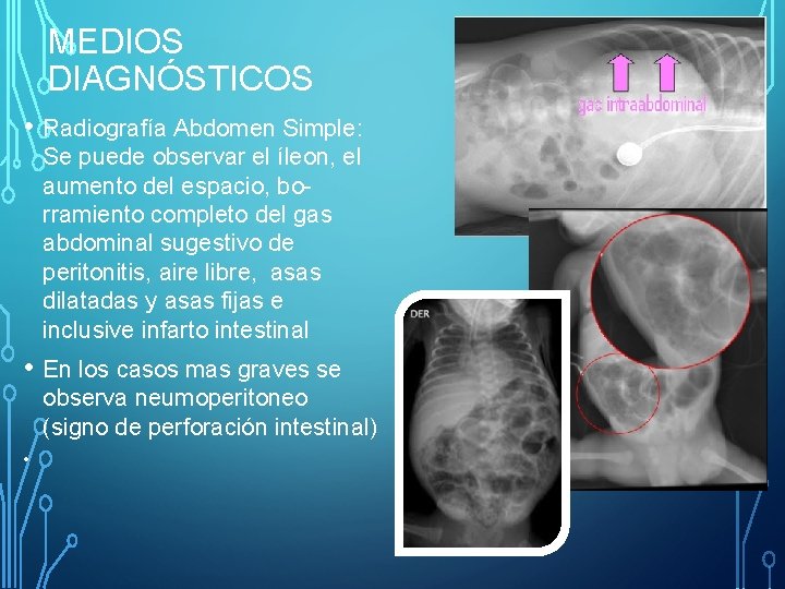 MEDIOS DIAGNÓSTICOS • Radiografía Abdomen Simple: Se puede observar el íleon, el aumento del