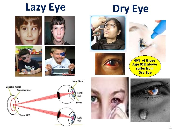 Lazy Eye Dry Eye 40% of those Age 60& above suffer from Dry Eye Lazy Eye Dry Eye 40% of those Age 60& above suffer from Dry Eye