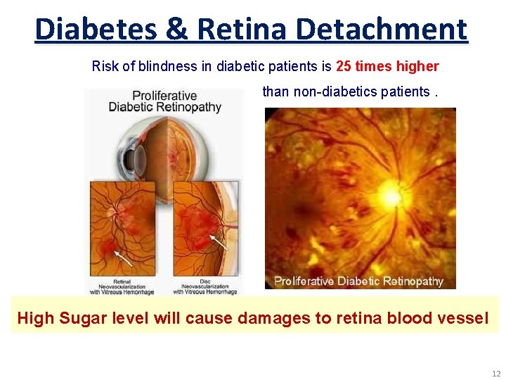 Diabetes & Retina Detachment Risk of blindness in diabetic patients is 25 times higher