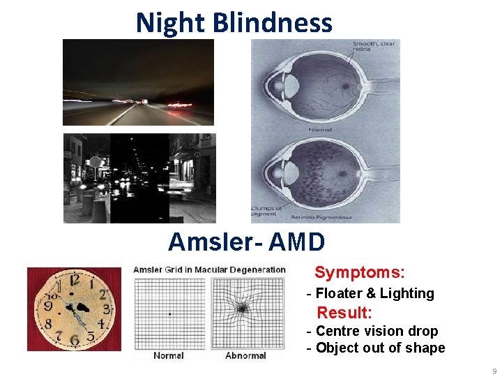 Night Blindness Amsler- AMD Symptoms: - Floater & Lighting Result: - Centre vision drop