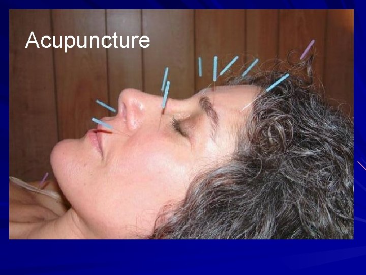 Acupuncture 