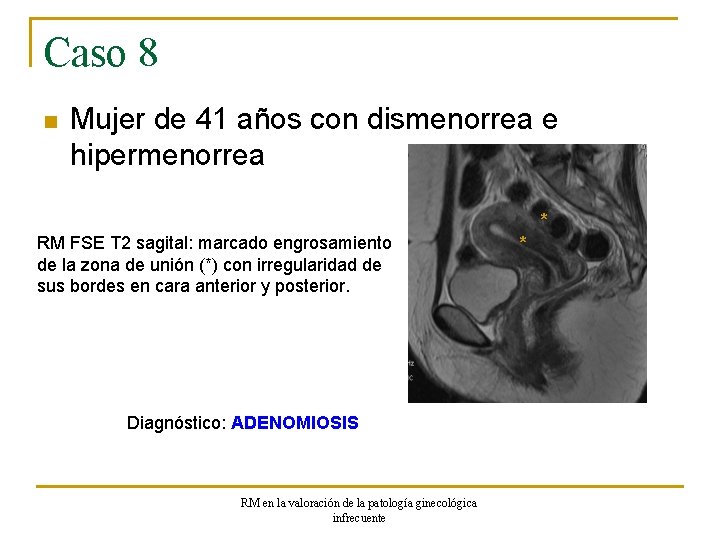 Caso 8 n Mujer de 41 años con dismenorrea e hipermenorrea * RM FSE