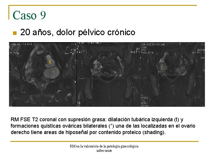 Caso 9 n 20 años, dolor pélvico crónico t * * RM FSE T