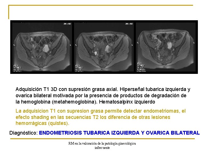 Adquisición T 1 3 D con supresión grasa axial. Hiperseñal tubarica izquierda y ovarica