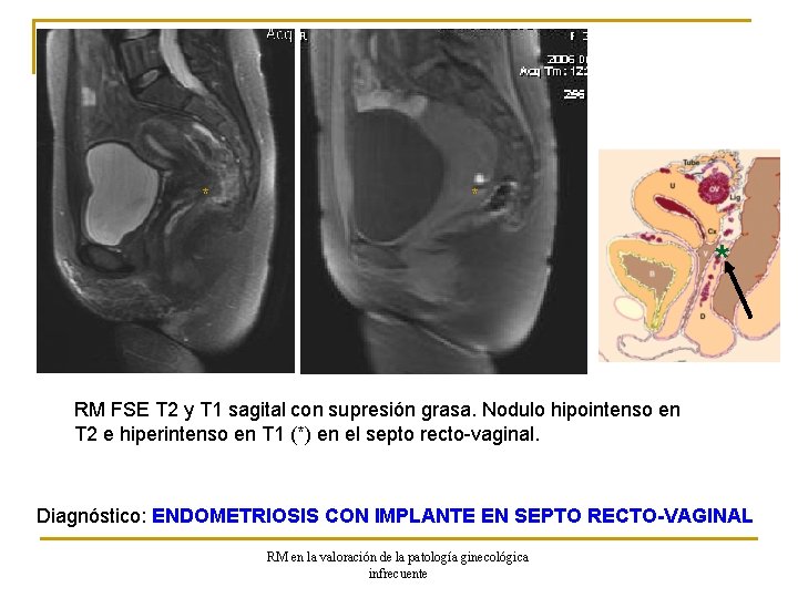 * * * RM FSE T 2 y T 1 sagital con supresión grasa.