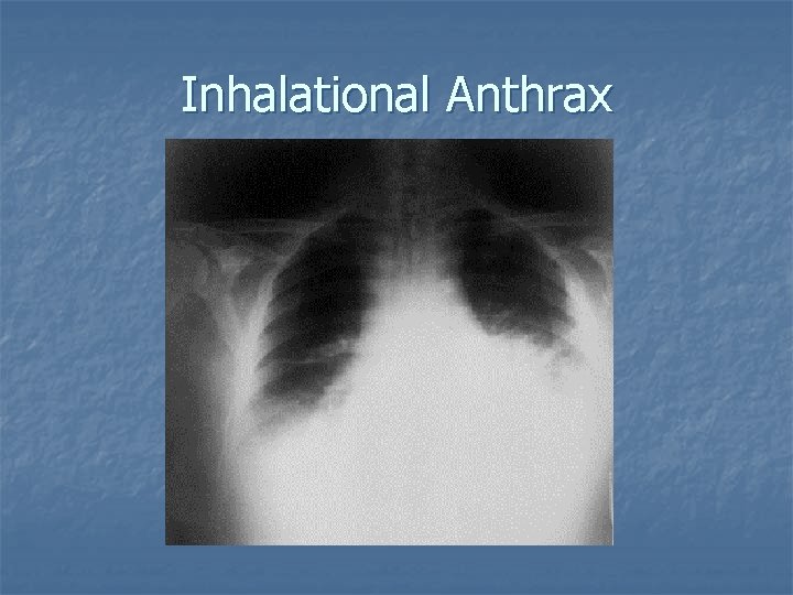 Inhalational Anthrax 