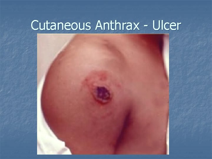 Cutaneous Anthrax - Ulcer 