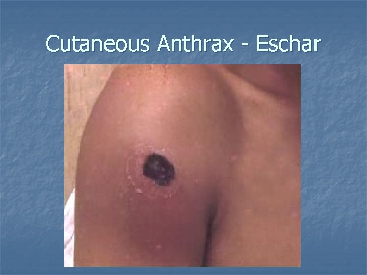 Cutaneous Anthrax - Eschar 