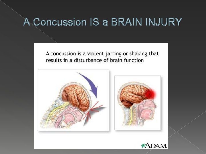 A Concussion IS a BRAIN INJURY 