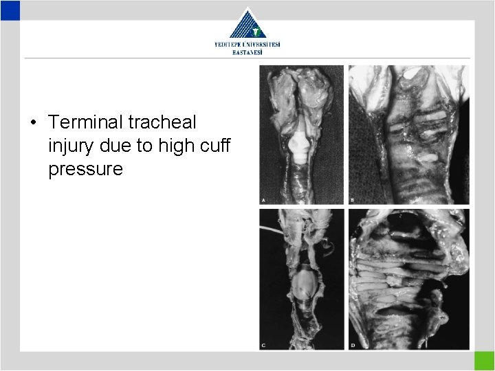  • Terminal tracheal injury due to high cuff pressure 