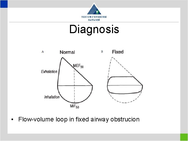 Diagnosis • Flow-volume loop in fixed airway obstrucion 