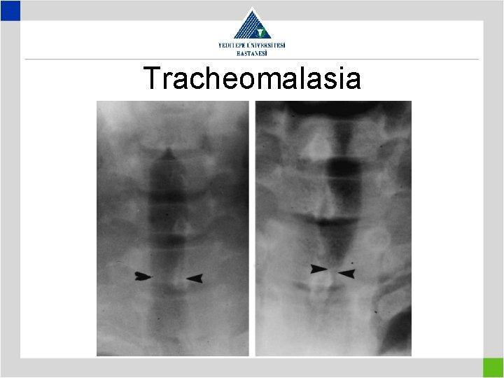 Tracheomalasia 