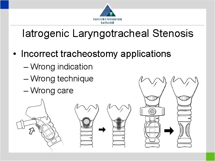 Iatrogenic Laryngotracheal Stenosis • Incorrect tracheostomy applications – Wrong indication – Wrong technique –