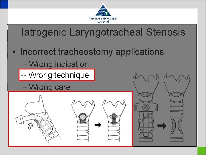 Iatrogenic Laryngotracheal Stenosis • Incorrect tracheostomy applications – Wrong indication -–- Wrong technique –