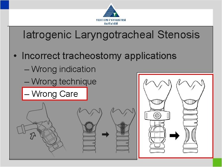 Iatrogenic Laryngotracheal Stenosis • Incorrect tracheostomy applications – Wrong indication – Wrong technique –