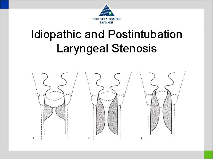 Idiopathic and Postintubation Laryngeal Stenosis 