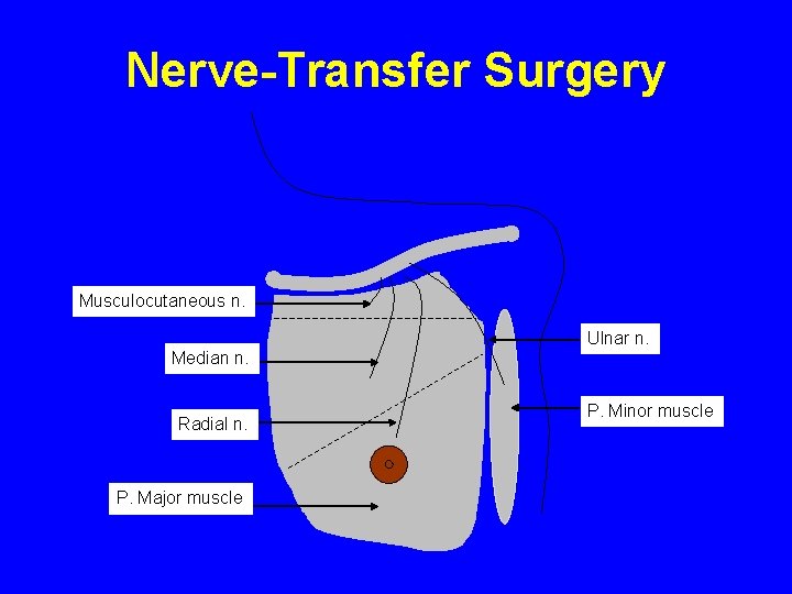Nerve-Transfer Surgery Musculocutaneous n. Ulnar n. Median n. Radial n. P. Major muscle P.