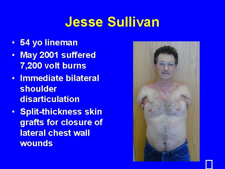 Jesse Sullivan • 54 yo lineman • May 2001 suffered 7, 200 volt burns