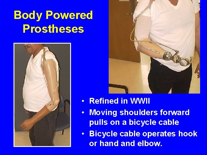 Body Powered Prostheses • Refined in WWII • Moving shoulders forward pulls on a