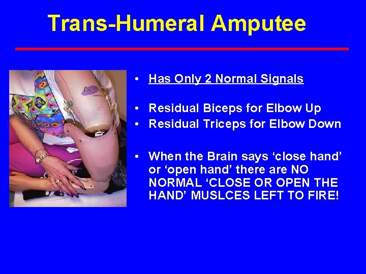 Trans-Humeral Amputee • Has Only 2 Normal Signals • Residual Biceps for Elbow Up